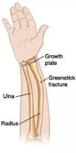 Child's Wrist Growth Plate