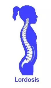 Children with Lordosis