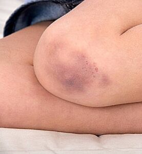knee cap instability