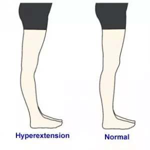 Knee Hyperextension