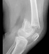 Broken Leg Compound Fracture