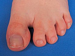 Fused Toes