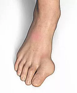 Epiphyseal Bracket Foot