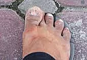 crooked big toe 