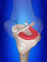 Labral Tear of the Hip