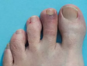 Toe Fracture