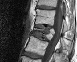 Pathological Fracture of the Spine