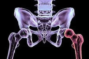hip dysplasia